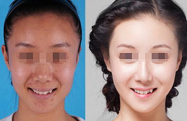熱拉提的治療效果好不好？多久起效？